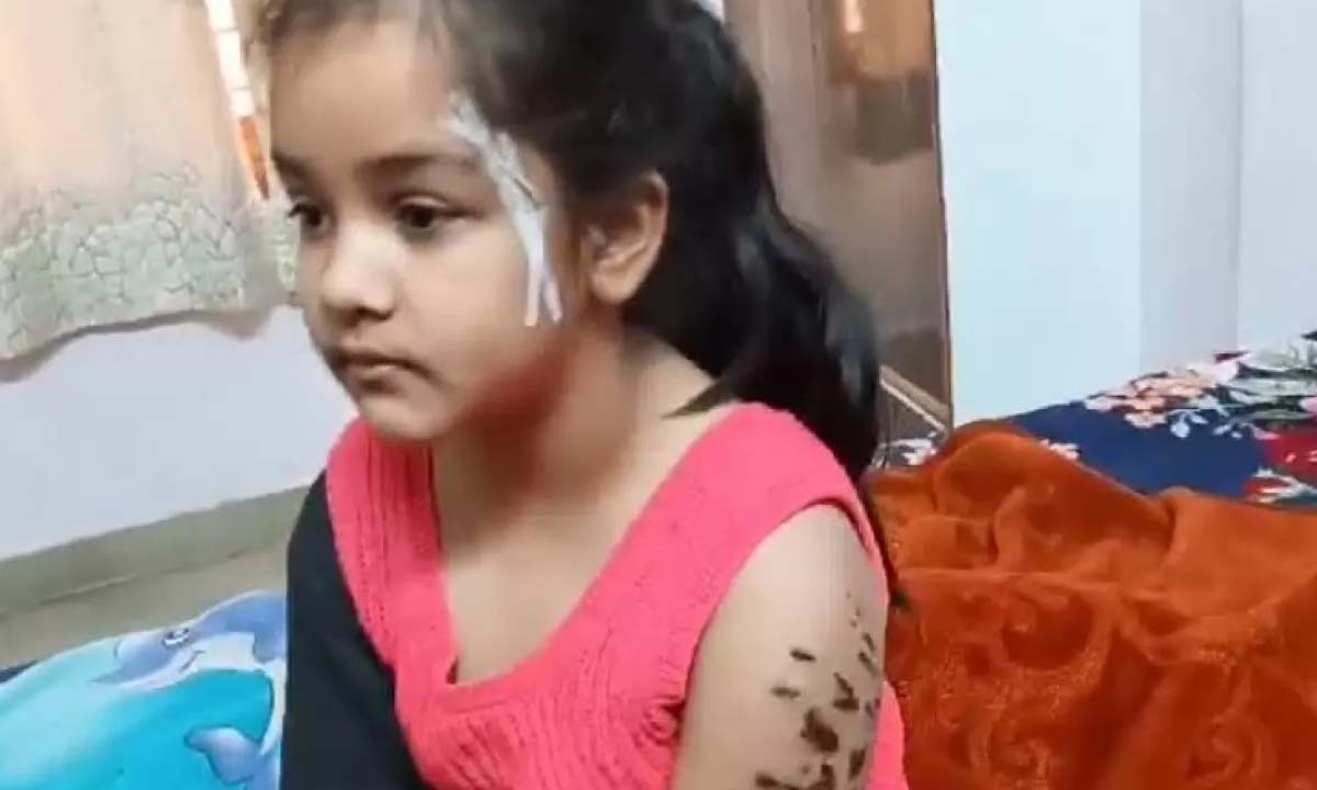 Delhi News: 7 year old girl suffered more than 15 injuries in the attack by American bully dog in Rohini