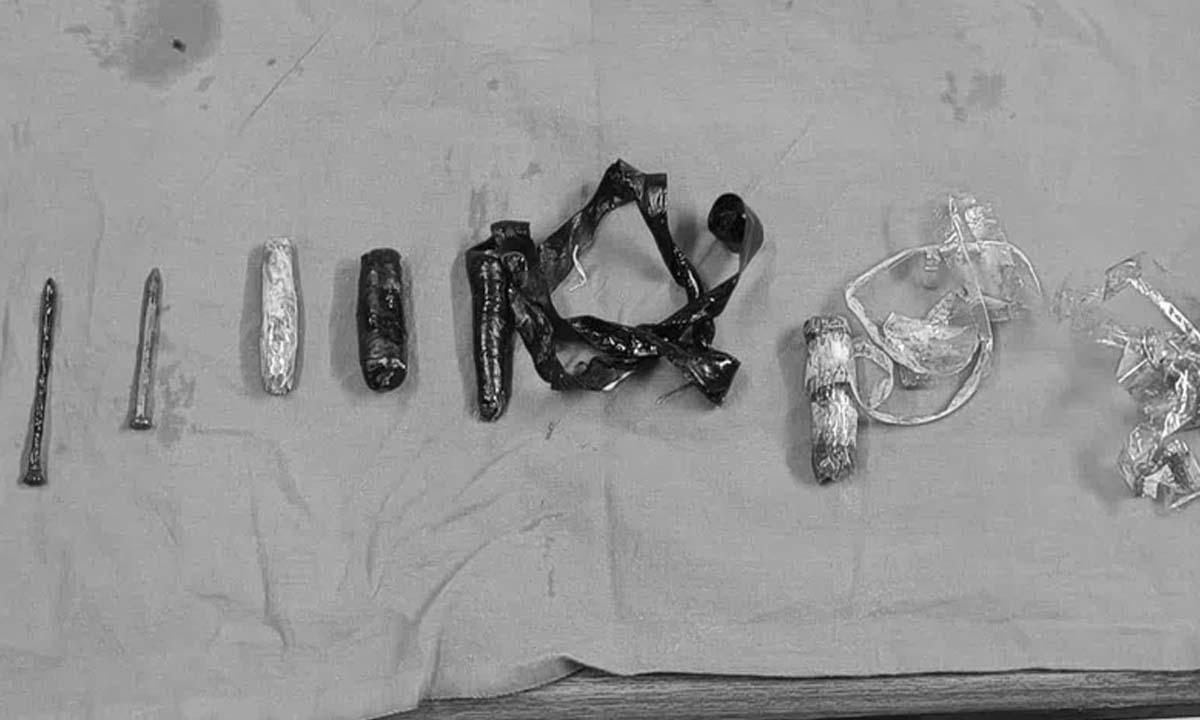 Hyderabad: OGH surgeons remove metal spikes from GI tract of 21-year-old inmate