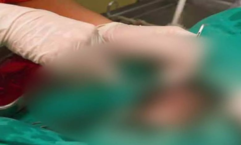 Government doctors sterilize pregnant woman, condition critical after operation